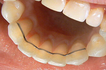 aparat retencyjny zdjęcie